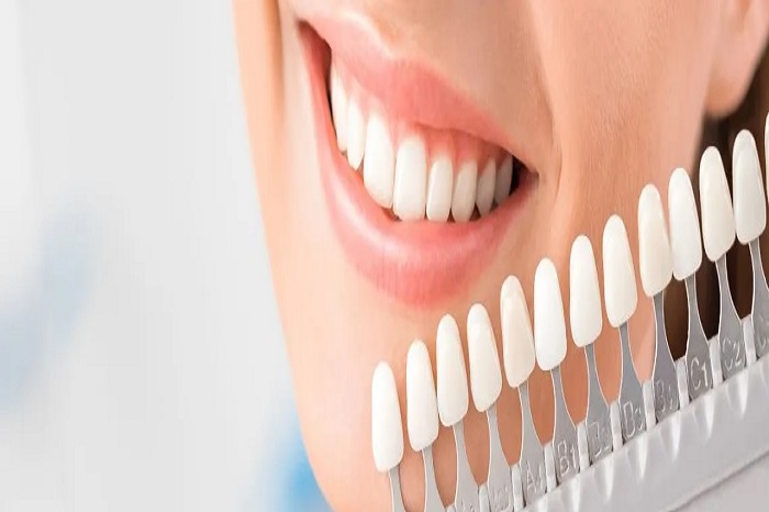 Teeth whitening Surrey